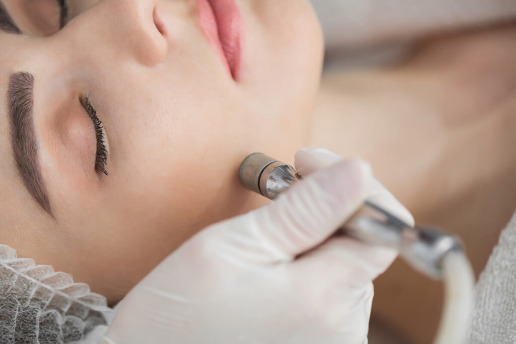 Microdermabrasion Treatments in Utica, NY